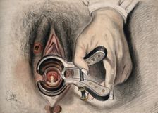 An infected sore on the female genitalia shown with the aid of a vaginal speculum, 1800-1899. Creator: Christopher D'Alton