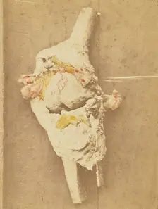 Arthropathie du genou, chez une ataxique (lésions anatomiques), 1871. Creator: Arthur de Montmeja