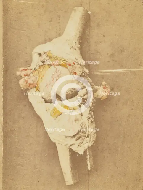 Arthropathie du genou, chez une ataxique (lésions anatomiques), 1871. Creator: Arthur de Montmeja.
