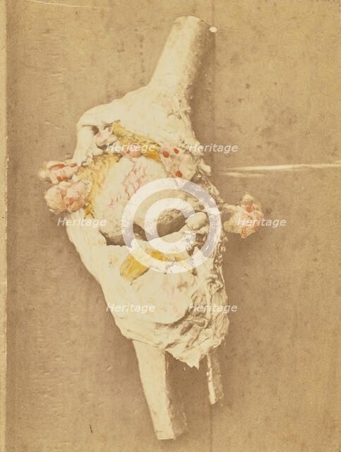 Arthropathie du genou, chez une ataxique (lésions anatomiques), 1871. Creator: Arthur de Montmeja.
