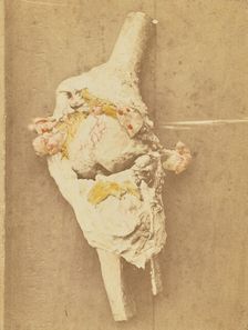 Arthropathie du genou, chez une ataxique (lésions anatomiques), 1871. Creator: Arthur de Montmeja