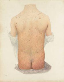 Back of a boy with skin disease, 1891. Creator: W Toogood Hill