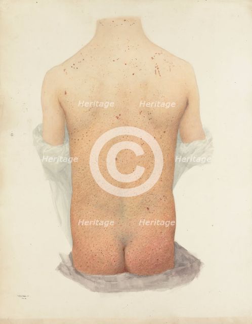 Back of a boy with skin disease, 1891. Creator: W Toogood Hill.