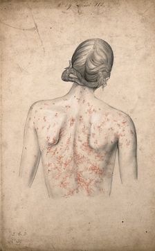 Back of a woman suffering from a rash of sores, 1855. Creator: Christopher D'Alton