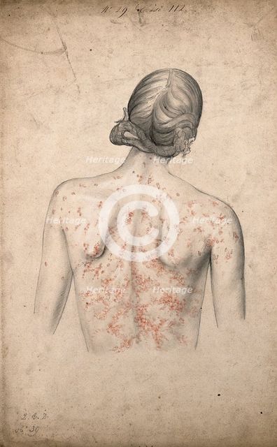 Back of a woman suffering from a rash of sores, 1855. Creator: Christopher D'Alton.