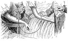 Blood transfusion, c1880