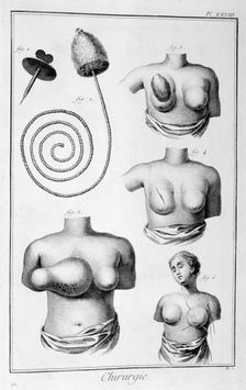 Breast surgery, 1751-1777