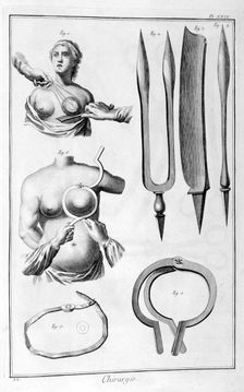 Breast surgery, 1751-1777
