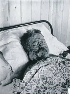 Gloucester smallpox epidemic, 1896: George Steel as a smallpox patient, 1896. Creator: HCF of Gloucester