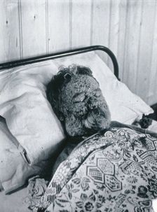 Gloucester smallpox epidemic, 1896: George Steel as a smallpox patient, 1896. Creator: HCF of Gloucester