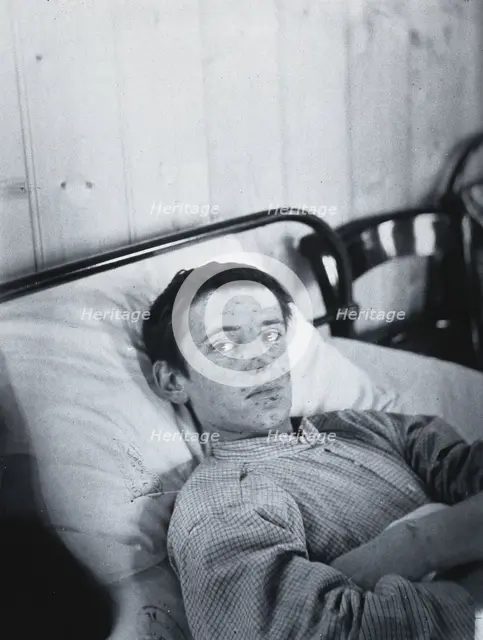 Gloucester smallpox epidemic, 1896: J  Mawson, a smallpox patient, 1896. Creator: HCF of Gloucester.