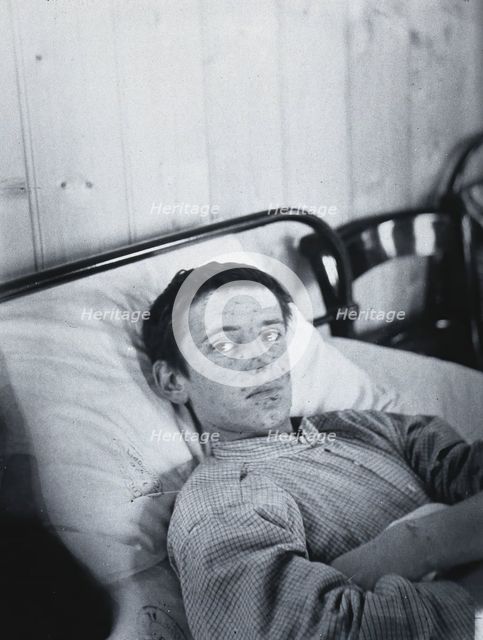 Gloucester smallpox epidemic, 1896: J  Mawson, a smallpox patient, 1896. Creator: HCF of Gloucester.