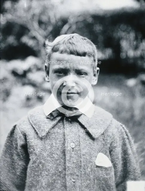 Gloucester smallpox epidemic, 1896: JR Evans, a smallpox patient, after recovery, 1896. Creator: HCF of Gloucester.