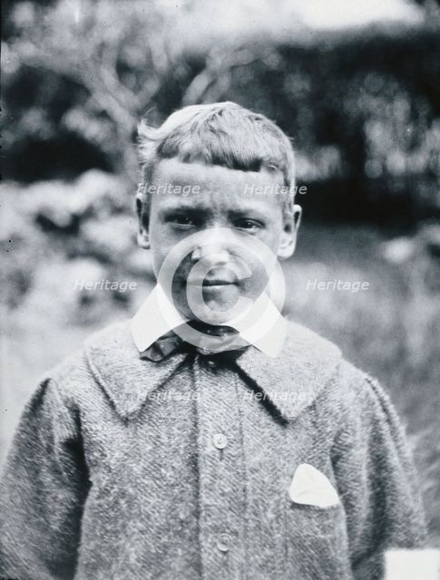 Gloucester smallpox epidemic, 1896: JR Evans, a smallpox patient, after recovery, 1896. Creator: HCF of Gloucester.