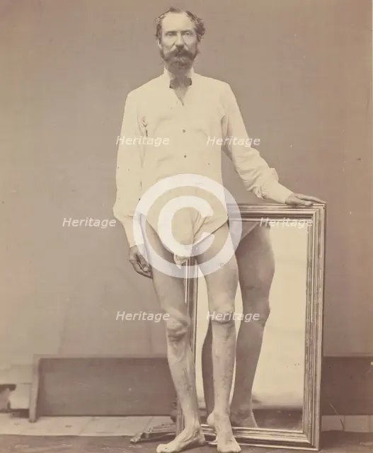 Gunshot Wound of Middle Third of Left Femur, 1865-67. Creator: William H. Bell.