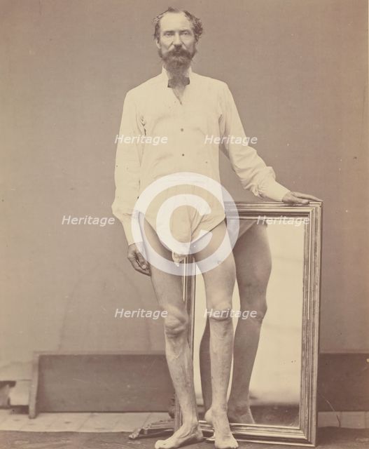 Gunshot Wound of Middle Third of Left Femur, 1865-67. Creator: William H. Bell.