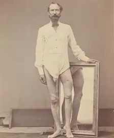 Gunshot Wound of Middle Third of Left Femur, 1865-67. Creator: William H. Bell