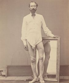 Gunshot Wound of Middle Third of Left Femur, 1865-67. Creator: William H. Bell