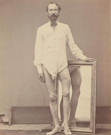 Gunshot Wound of Middle Third of Left Femur, 1865-67. Creator: William H. Bell