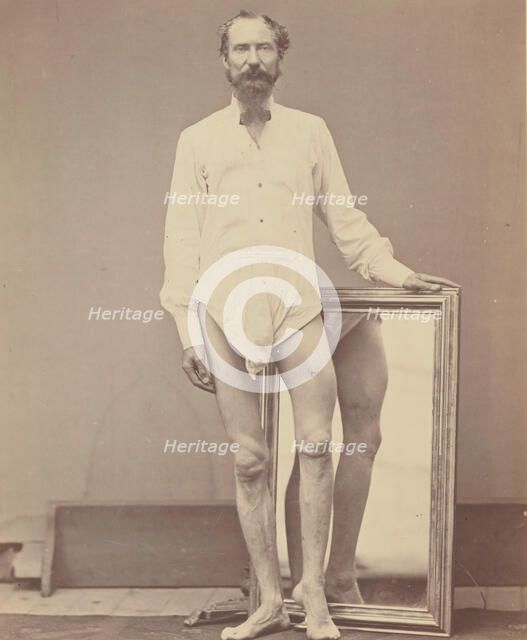 Gunshot Wound of Middle Third of Left Femur, 1865-67. Creator: William H. Bell.