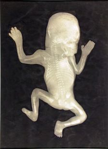 Degree of Ossification of a Five-Month-Old Fetus (Degré d'ossification d'un Foetus de cinq mois), 18 Creator: Unknown