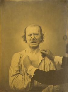 Discontent, bad humor, 1854-1856, printed 1862. Creator: Duchenne de Boulogne