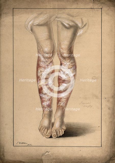 Diseased skin on the legs of a man suffering from psoriasis, 1873. Creator: Christopher D'Alton.