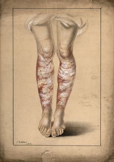 Diseased skin on the legs of a man suffering from psoriasis, 1873. Creator: Christopher D'Alton