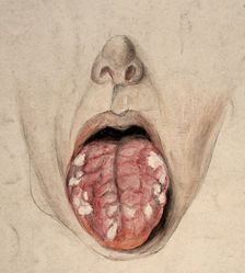 Diseased tissue on the tongue of a man suffering from syphilis, (18)57. Creator: Christopher D'Alton