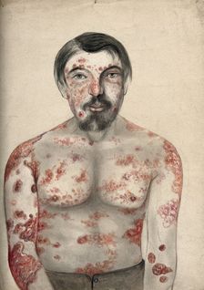 Diseased tissue on the face, shoulders arms and torso of a man suffering from psoriasis..., (18)66. Creator: Christopher D'Alton