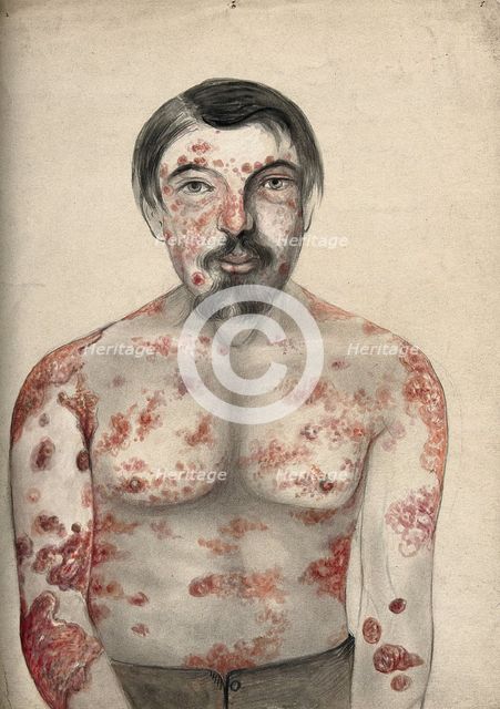Diseased tissue on the face, shoulders arms and torso of a man suffering from psoriasis..., (18)66. Creator: Christopher D'Alton.