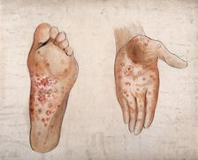 Diseased tissue on the palm of the hand and sole of the foot of a man, (1853?). Creator: Christopher D'Alton