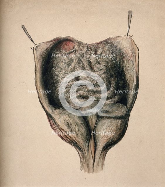 Dissection of diseased intestines, (1851?). Creator: Unknown.