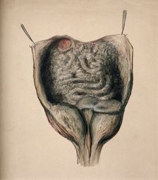 Dissection of diseased intestines, (1851?). Creator: Unknown