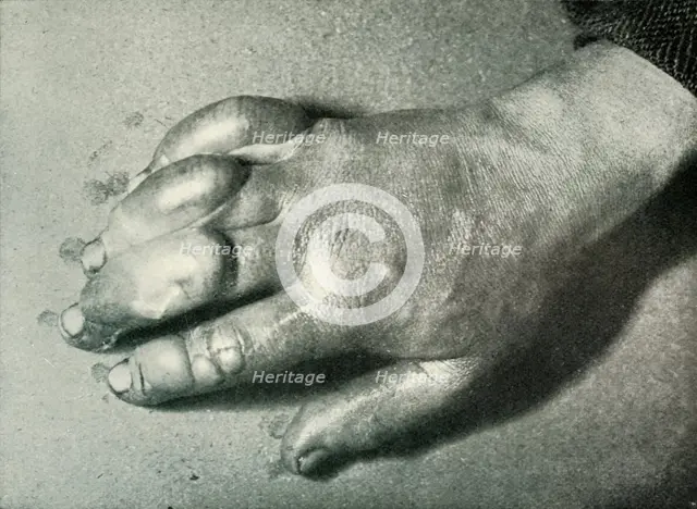 'Dr. Atkinson's Frost-Bitten Hand', 5 July 1911, (1913). Artist: Herbert Ponting.