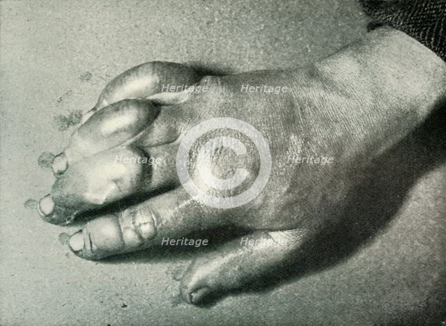 'Dr. Atkinson's Frost-Bitten Hand', 5 July 1911, (1913). Artist: Herbert Ponting.