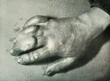 Dr. Atkinson's Frost-Bitten Hand 5 July 1911, (1913). Artist: Herbert Ponting