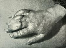 Dr. Atkinson's Frost-Bitten Hand 5 July 1911, (1913). Artist: Herbert Ponting