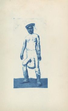 Elephantiasis, c. 1870s. Creator: Unknown