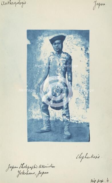 Elephantiasis, c. 1870s. Creator: Unknown.