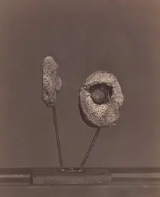 Excised Knee Joint. A Round Musket Ball in the Inner Condyle of the Right Femur [Gardin..., 1866-67. Creator: William H. Bell