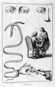 Eye surgery, 1751-1777