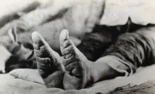 Feet of a Chinese woman, showing the effect of foot-binding, between 1900 and 1999. Creator: Unknown