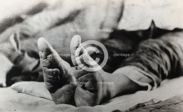 Feet of a Chinese woman, showing the effect of foot-binding, between 1900 and 1999. Creator: Unknown.