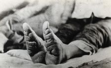 Feet of a Chinese woman, showing the effect of foot-binding, between 1900 and 1999. Creator: Unknown