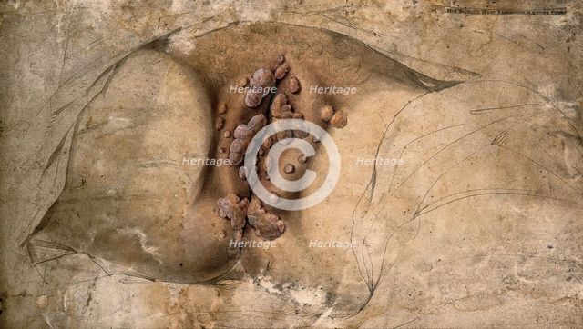 Female genitalia covered with syphilitic warts, c1824. Creator: Unknown.