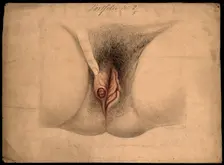 Female genitalia held open by a finger to show an area of diseased tissue, (18)66. Creator: Christopher D'Alton