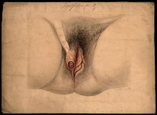 Female genitalia held open by a finger to show an area of diseased tissue, (18)66. Creator: Christopher D'Alton