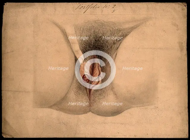 Female genitalia held open by a finger to show an area of diseased tissue, (18)66. Creator: Christopher D'Alton.