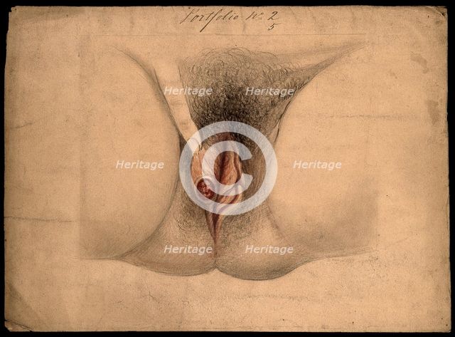 Female genitalia held open by a finger to show an area of diseased tissue, (18)66. Creator: Christopher D'Alton.